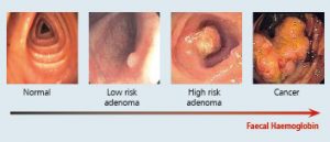 Colon-Normal-to-Cancer